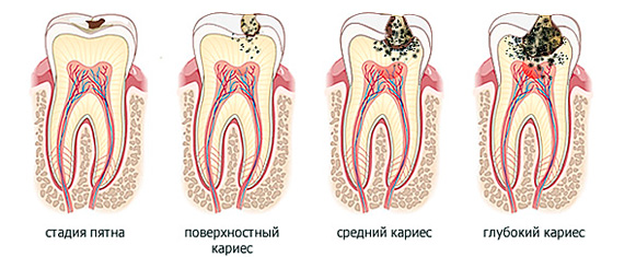 Лечение кариеса, пульпита, пломбирование каналов