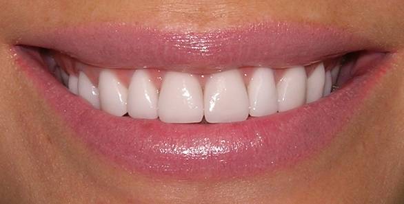 Restoration of Teeth with Veneers