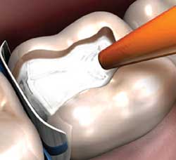 Light-Cured Filling Placement